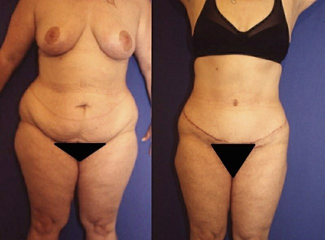 abdominoplastie