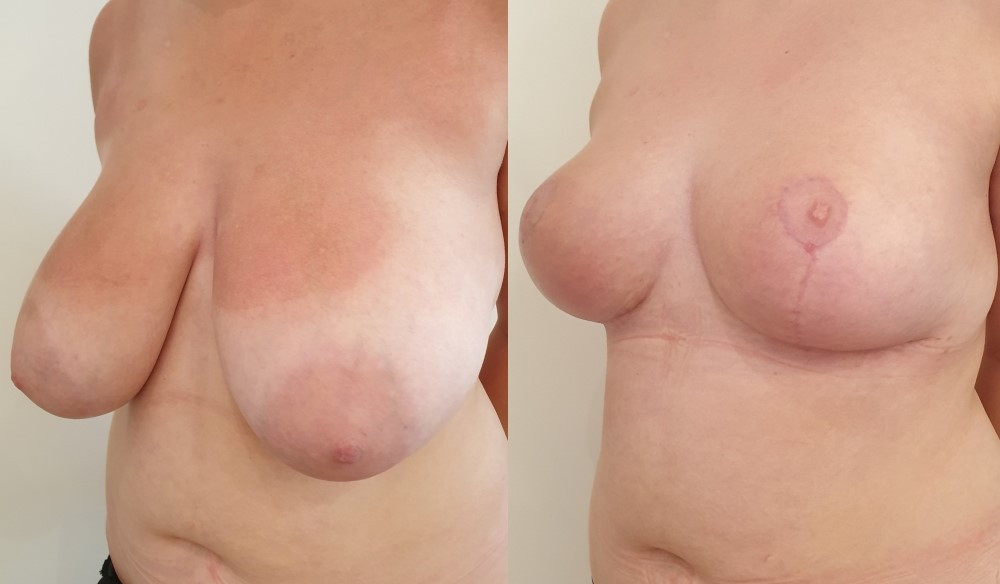 Avant/Après Réduction mammaire