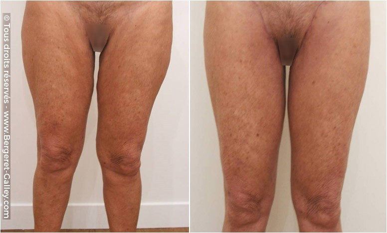 Before/After Thigh Lift