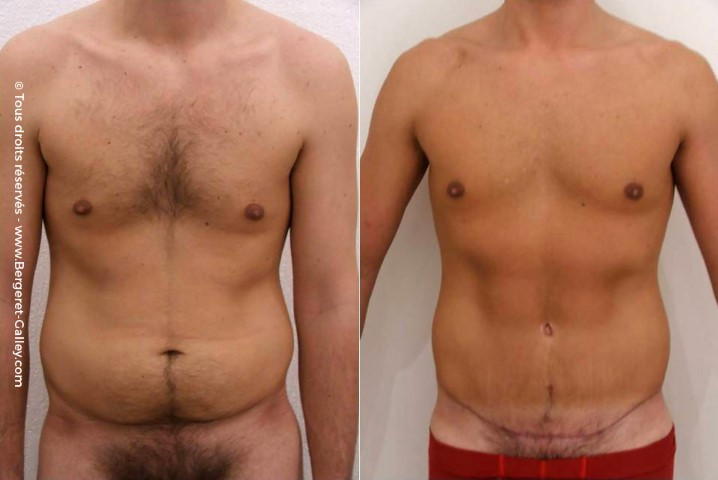 Plastie abdominale homme