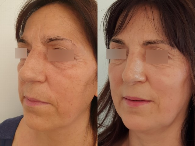 Résultat avant/après rhinoplastie