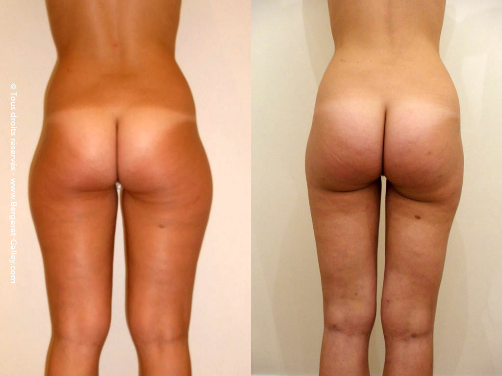 Legs and knees Liposuction