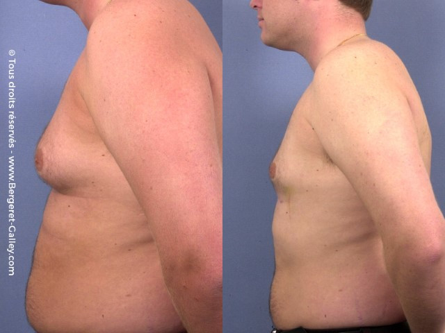 Lipoaspiration de Gynécomastie