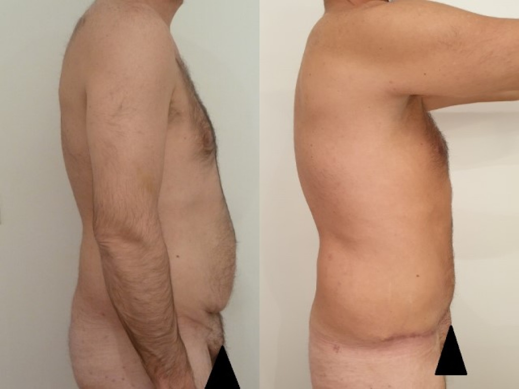 Men Abdominoplasty