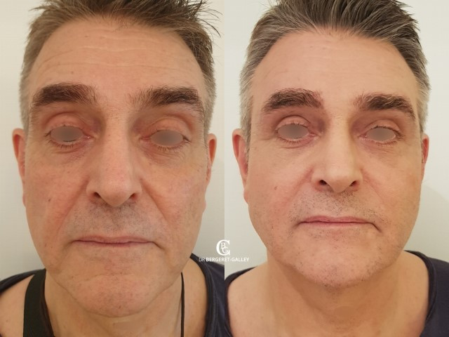 Lipofilling du visage