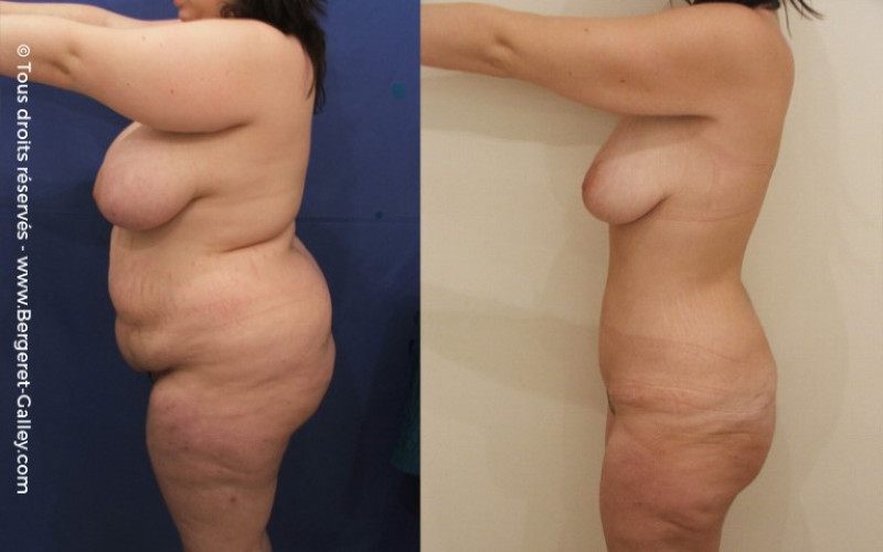 Abdominoplasty before and after, Flat belly surgery