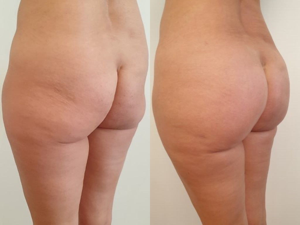 Before/After buttock implants