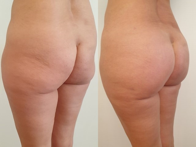 Augmentation des fesses par implants