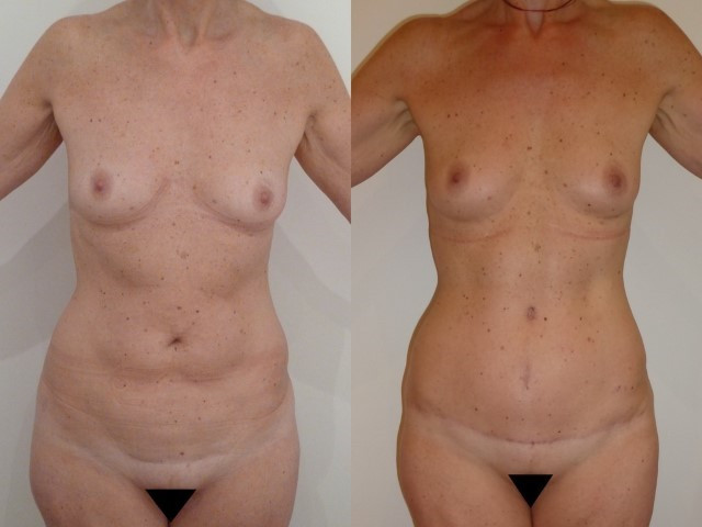 abdominoplastie