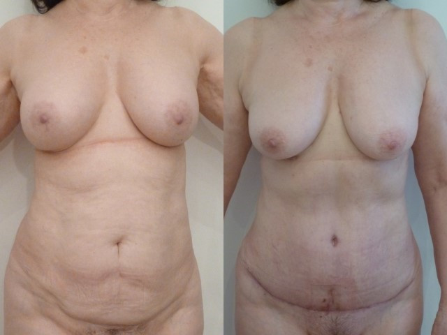 abdominoplastie