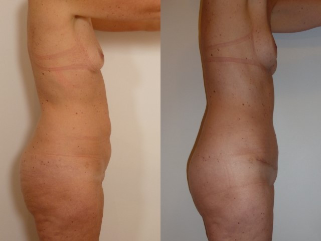 abdominoplastie