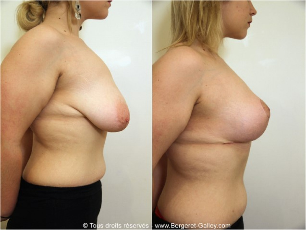 Breast reduction