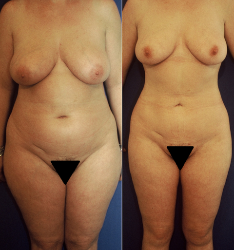 abdominoplastie