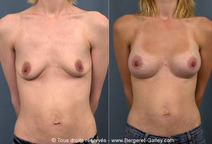 Photo avant/après augmentation mammaire avec des prothèses 250ml