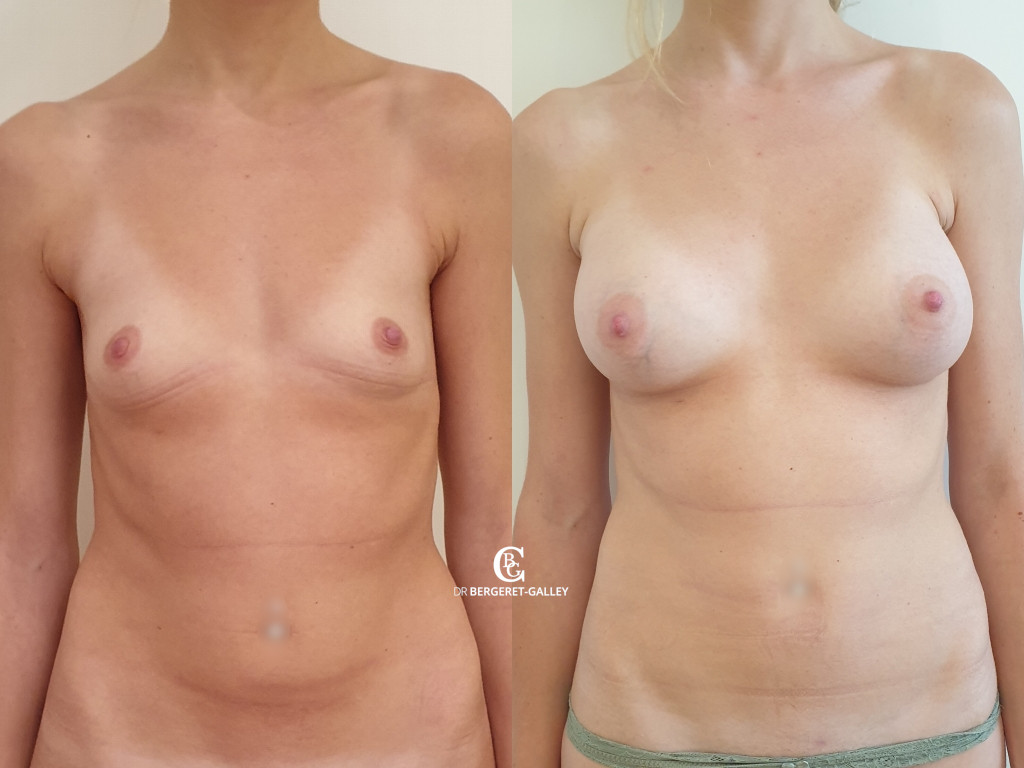 Photo avant/après augmentation mammaire avec des prothèses