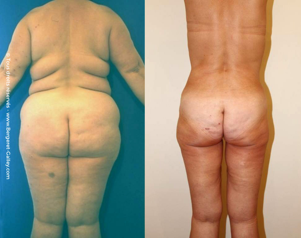 Before/After Bodylift