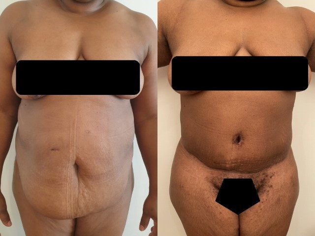 abdominoplastie