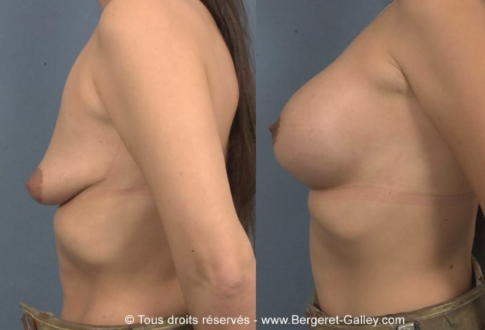 Photo avant/après augmentation mammaire avec des prothèses 285ml