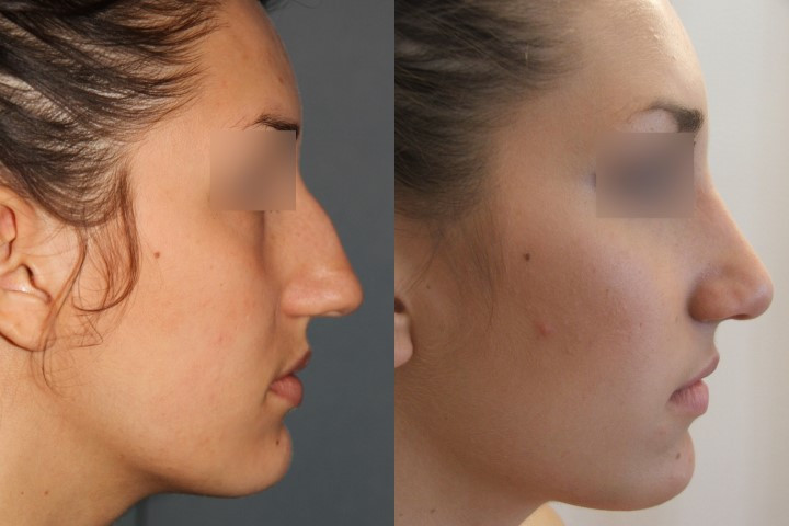 Résultat avant/après rhinoplastie