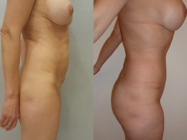 abdominoplastie