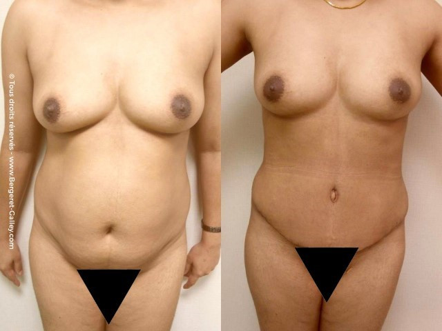 Abdominoplastie de face.