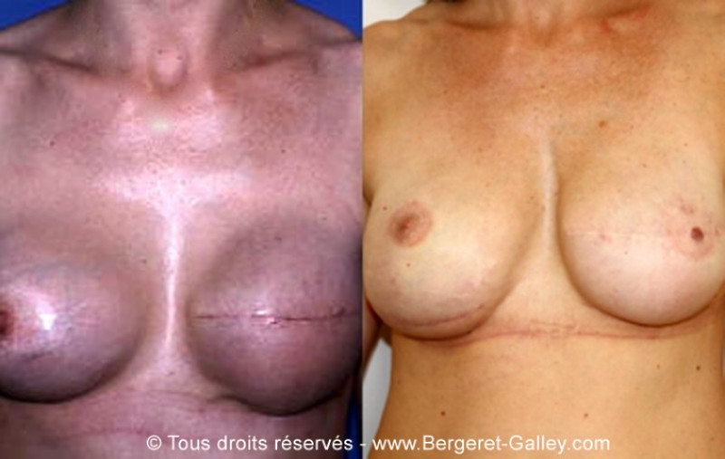 Before/After breast Reconstruction