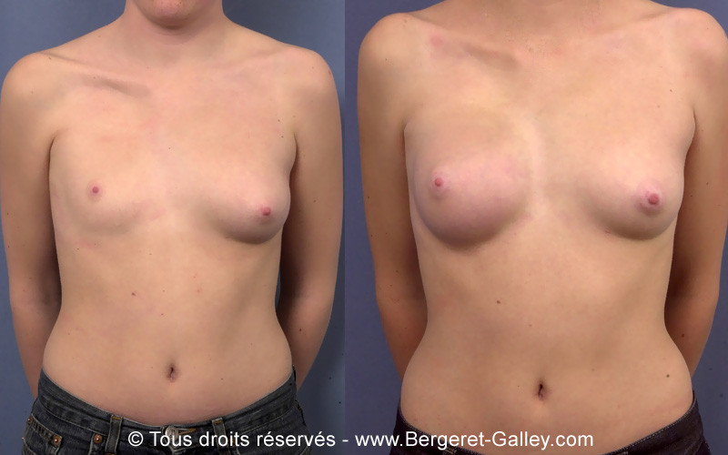 Photo avant/après augmentation mammaire avec des prothèses suite un syndrome de Poland