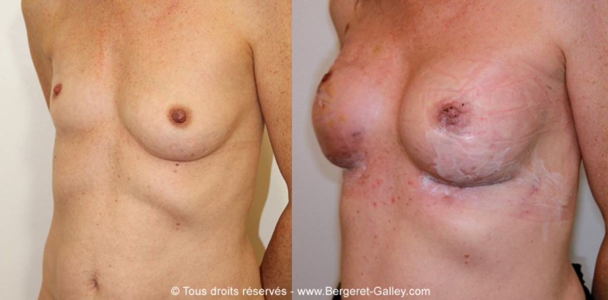 Before/After breast Reconstruction