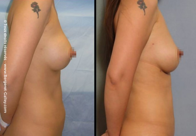 Lipofilling seins