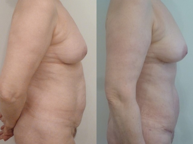 abdominoplastie