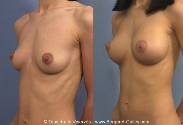 Photo avant/après augmentation mammaire avec des prothèses 310ml