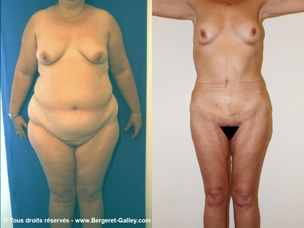 Before/After Bodylift