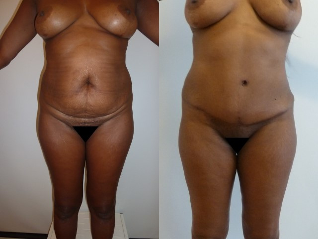 abdominoplastie