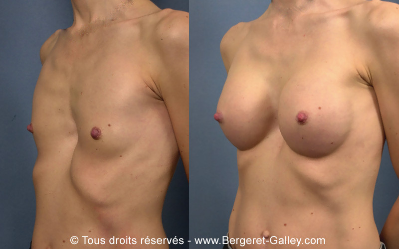 Photo avant/après augmentation mammaire avec des prothèses suite une malformation congénitale de profil