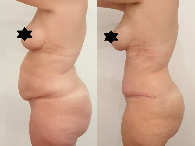 Avant/après abdominoplastie avec le Dr Bergeret-Galley chirurgien esthétique à Paris