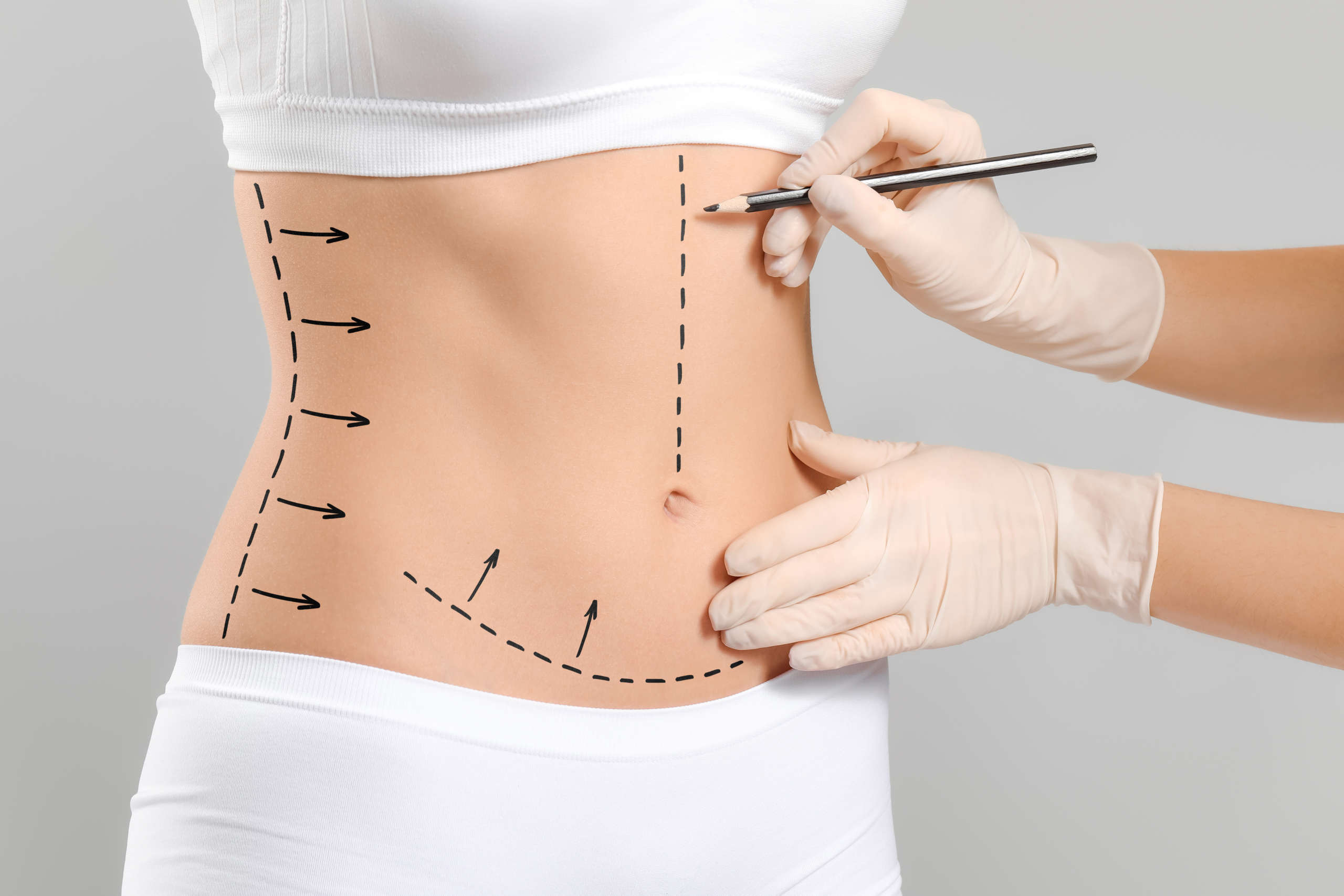 Abdominoplastie-1.jpg