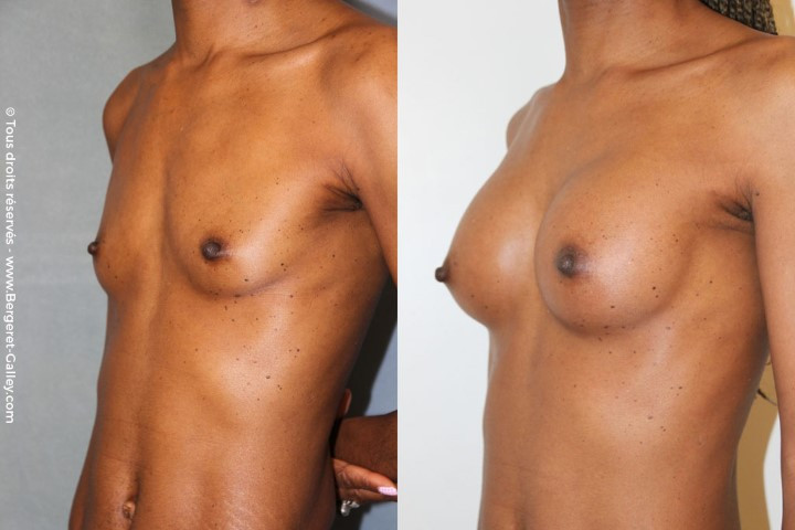 Lipofilling des seins