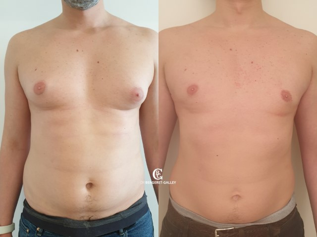 Lipoaspiration de Gynécomastie