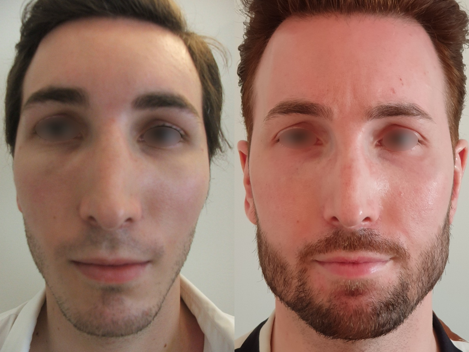 Avant/Après masculinisation du visage un homme