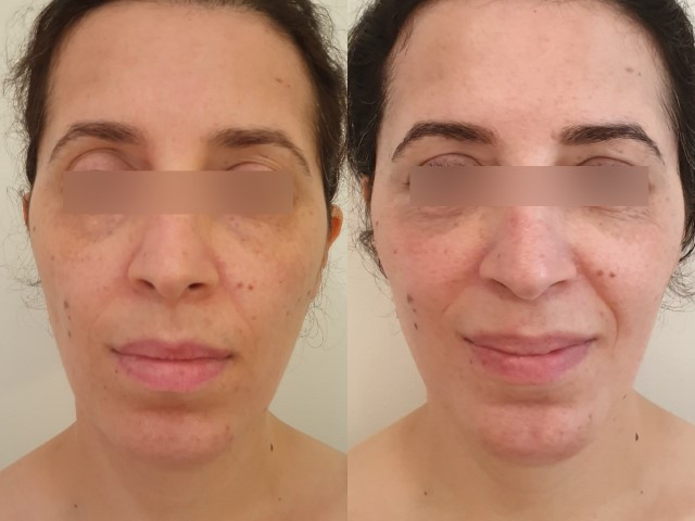 Lipofilling du visage