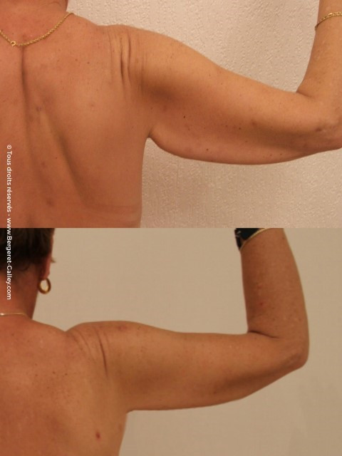 Brachioplasty