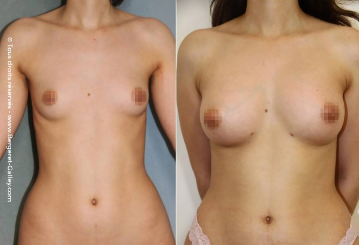 Lipofilling seins