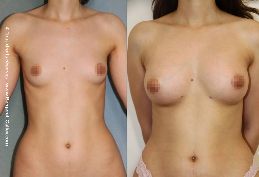 lipofilling breasts