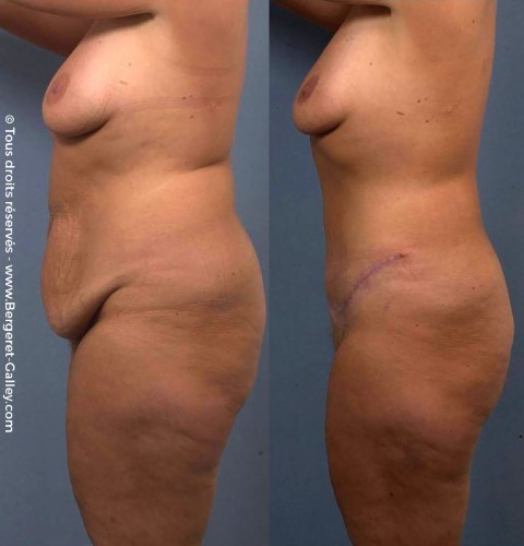 Photo avant/après d'une Plastie abdominale chez une femme