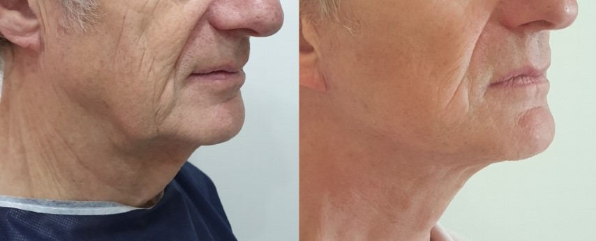 lifting-relachement-ovale-visage
