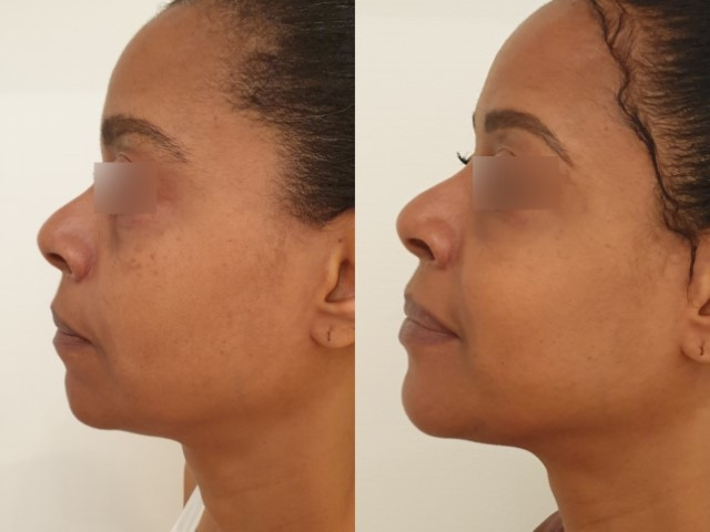 Lipofilling du visage