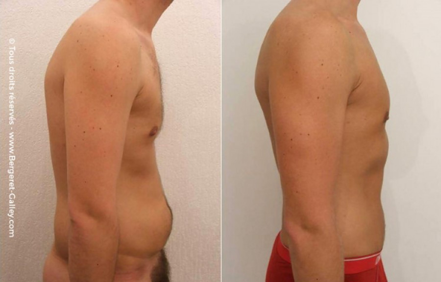 Men Abdominoplasty