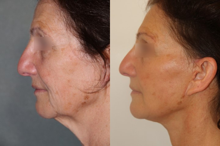 lifting visage et cou avant après