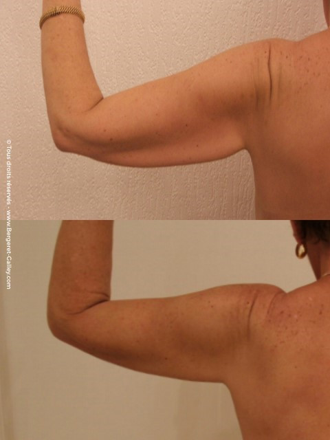 Brachioplasty