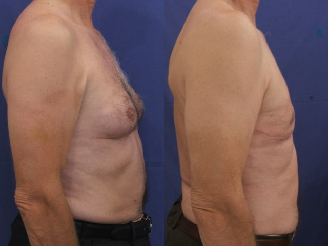 Lipoaspiration de Gynécomastie